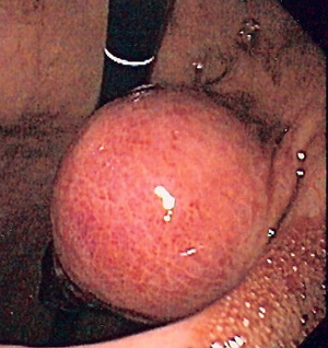 New Therapeutic Options in Gastrointestinal Stromal Tumors