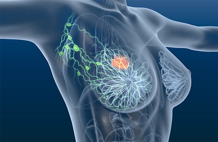 Camizestrant Plus Ribociclib Shows Promise in Advanced Breast Cancer - News Directory 3
