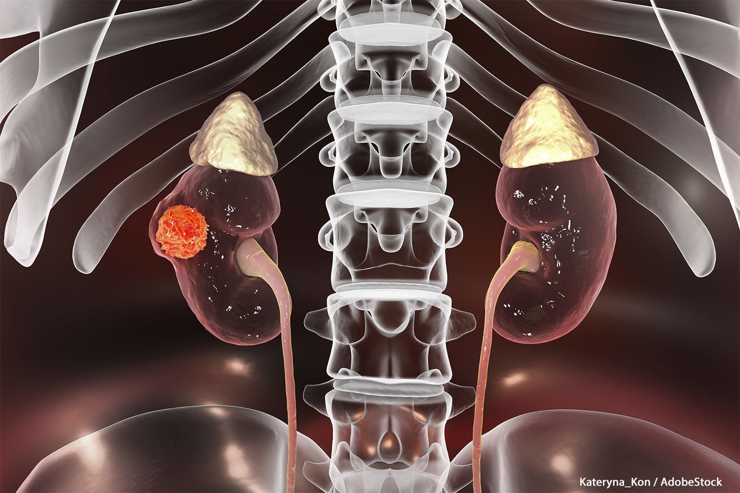 Patient for Atezolizumab vs Sunitinib in Renal