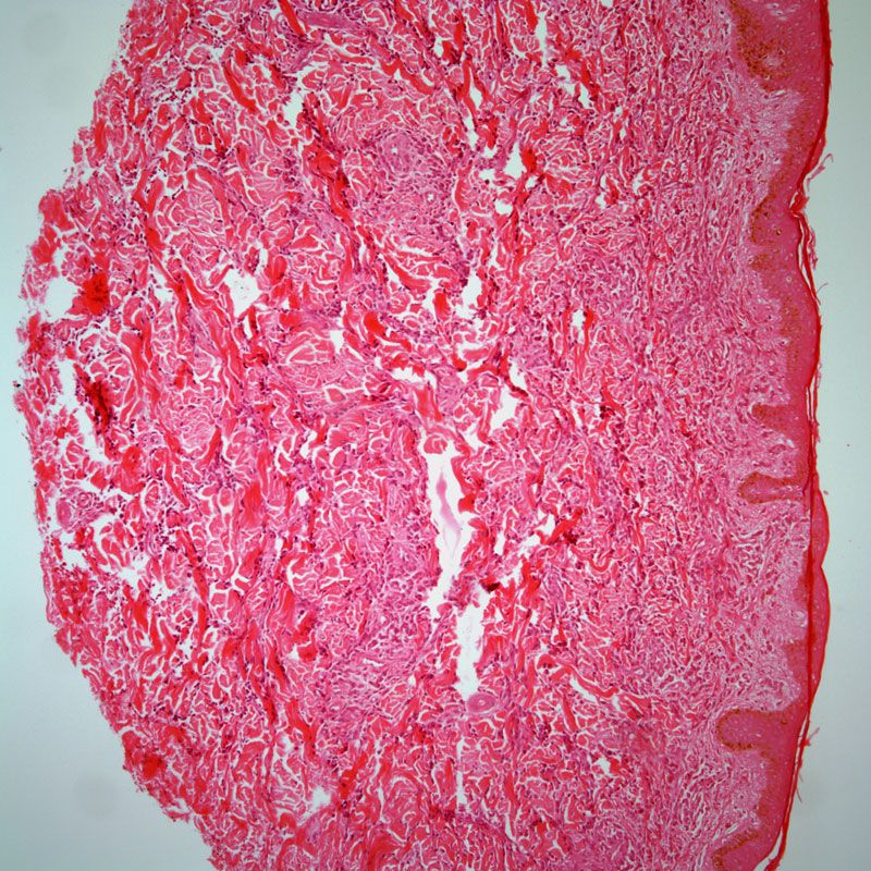 Investigators pause their evaluation of SC-DARIC33 in pediatric relapsed/refractory acute myeloid leukemia following a grade 5 serious adverse effect in the phase 1 PLAT-08 trial.