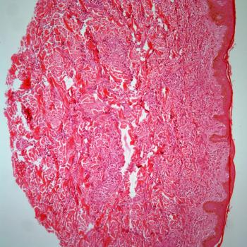 Investigators pause their evaluation of SC-DARIC33 in pediatric relapsed/refractory acute myeloid leukemia following a grade 5 serious adverse effect in the phase 1 PLAT-08 trial.