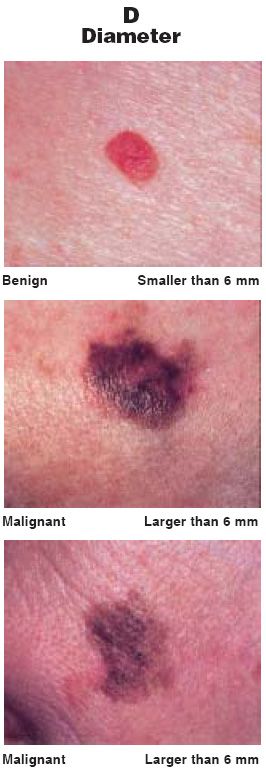 The ABCDs Of Moles And Melanomas