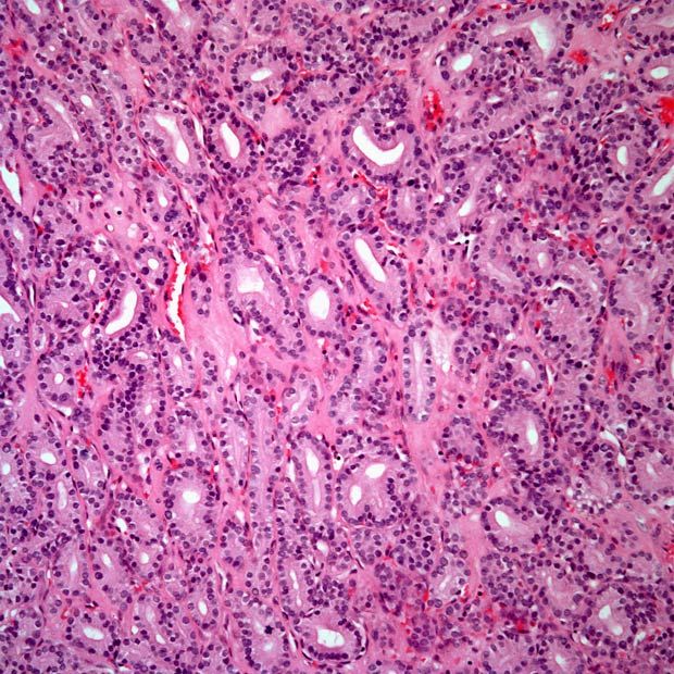 Slide Show: Follicular Thyroid Carcinoma and Hurthle Cell ...

