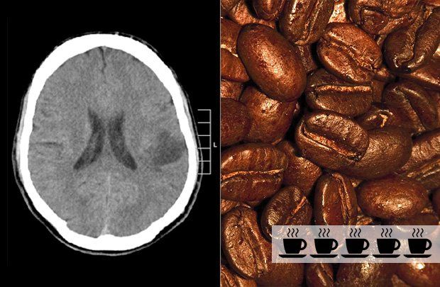 Coffee and glioma risk