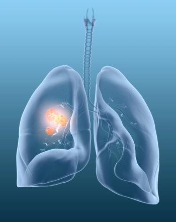 lung cancer
