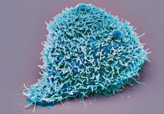 Recap: Experts Discuss Treatment Methodologies in RCC