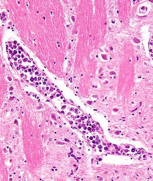 Ibrutinib/Venetoclax Combo Improves PFS in Relapsed/Refractory MCL