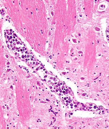 Several discrepancies in care must be considered to properly address psychological needs in patients with lymphoma, including patient/doctor communication, information provision, and applying distress guidelines.