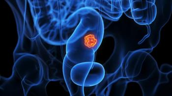 Dostarlimab Yields Sustained cCRs in dMMR/MSI-H Locally Advanced Rectal Cancer: © Sebastian Kaulitzki - stock.adobe.com