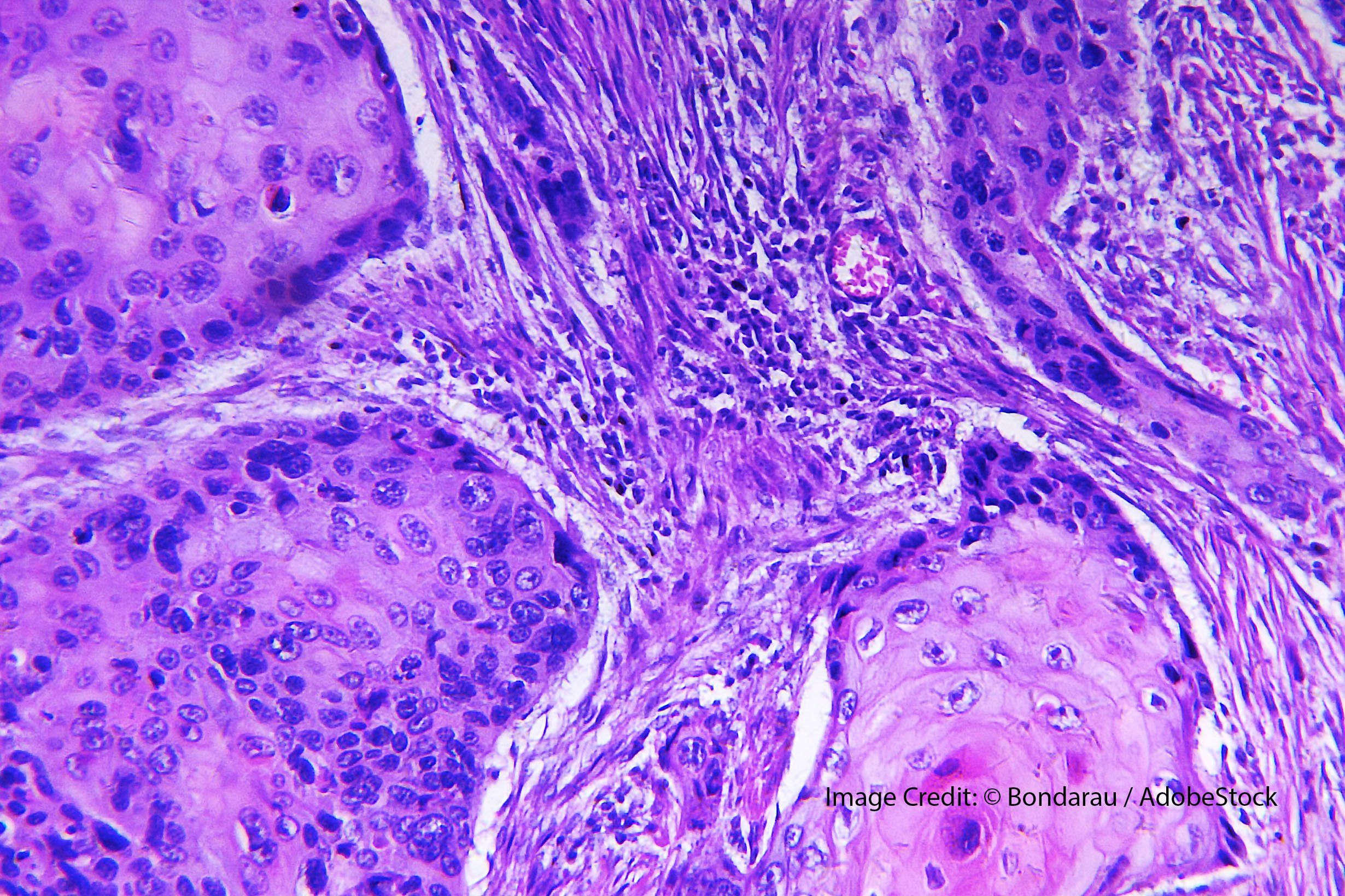 Precursor Immunotherapy to Prevent Squamous Cell Carcinoma