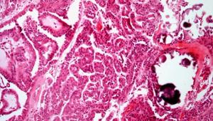 Right Kidney Mass Found in 52-Year-Old Patient