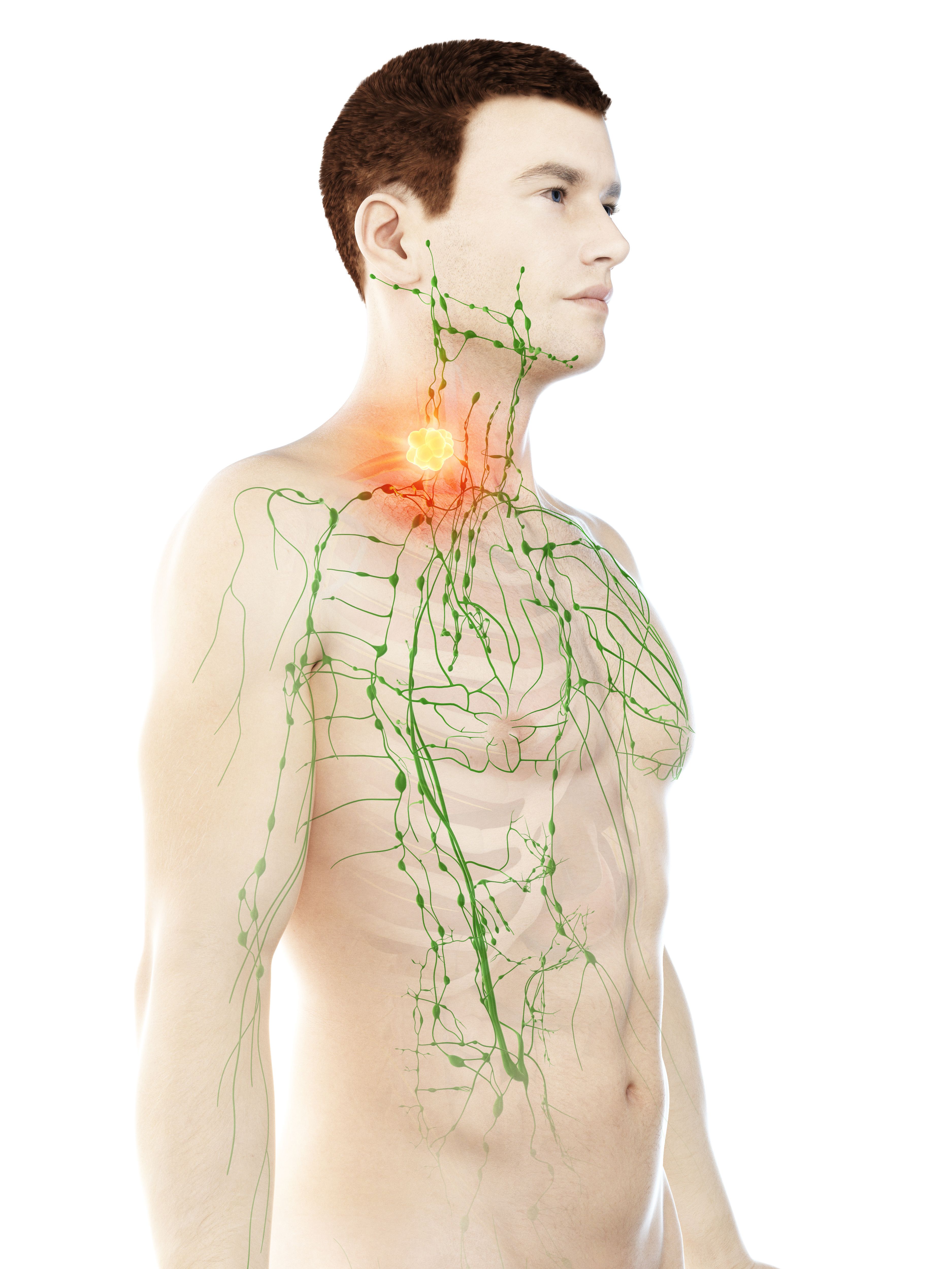 Head and Neck Cancer