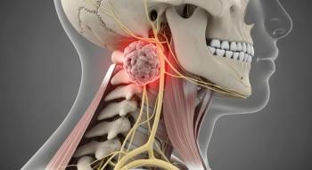 Anatomical skull and neck model with a highlighted tumor. Oncology and nerve system disorders. Illustration of a large growth or cyst located near the cervical spine and facial nerves | Image Credit: © designhunt - stock.adobe.com