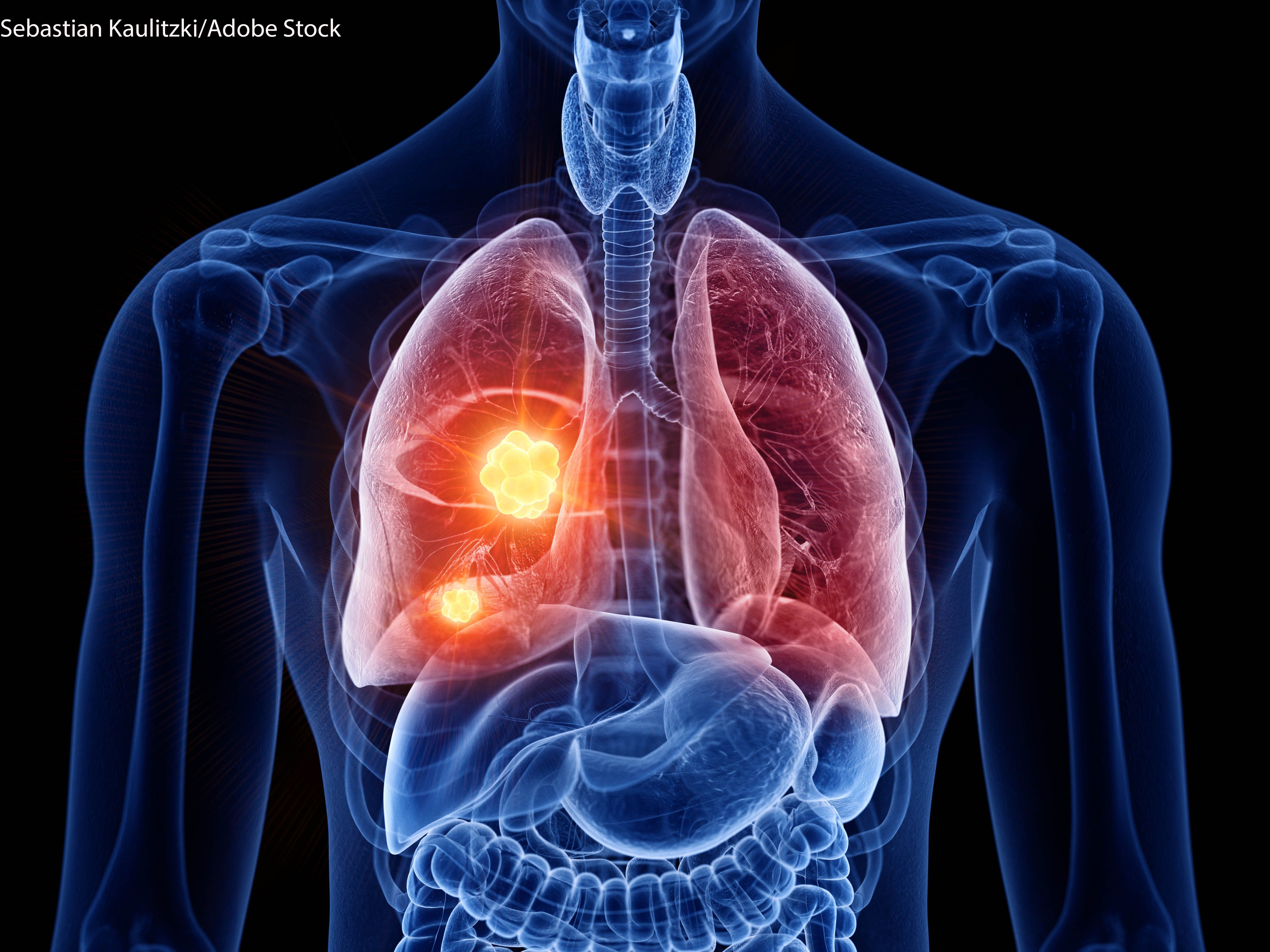 In June 2025, the FDA granted accelerated approval to datopotamab deruxtecan (dato-DXd) as a treatment for patients with pretreated EGFR-mutant metastatic non–small cell lung cancer.