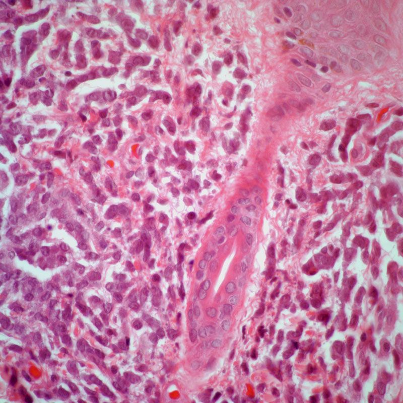 Despite an improvement in disease-free survival, patients 60 years or over with acute myeloid leukemia do not appear to have a survival benefit from allo-HCT during first complete remission compared with consolidation chemotherapy.