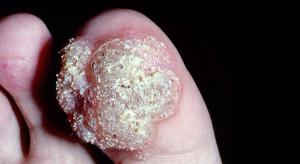 Rapidly Growing Pedal Lesions Following Chemotherapy