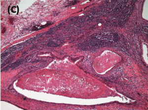 Management of Residual Disease After First-line Chemotherapy in a Patient With a Nonseminomatous Germ Cell Tumor