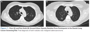 Ground-Glass Opacity Lung Nodules in the Era of Lung Cancer CT Screening:  Radiology, Pathology, and Clinical Management