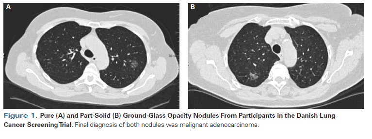 Ground-Glass Opacity Lung Nodules in the Era of Lung Cancer CT ...