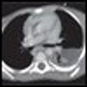 Pediatric Anaplastic Large Cell Lymphoma Presenting as Generalized Lymphadenopathy