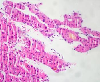 A retrospective review identified that clinical practice patterns have changed from 2002 to 2020, with the use of immunotherapy increasing as chemotherapy and radiation therapy use has decreased for patients with Merkel cell carcinoma.