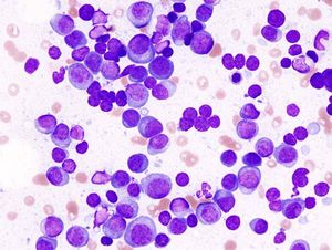 Despite Early Termination Due to Low Accrual, alloHCT Plus Reduced Intensity Conditioning Safe in Myeloma