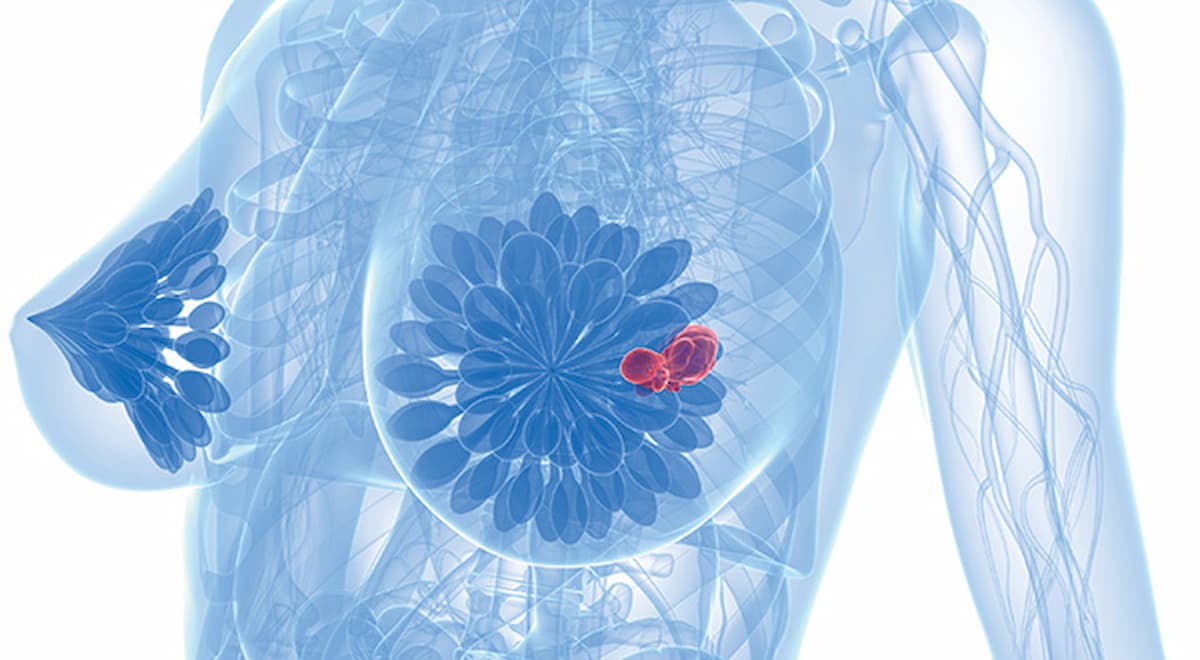 Updated results from the POSITIVE trial found that patients younger than 35 years had a higher likelihood of achieving pregnancy during an endocrine therapy pause for HR-positive breast cancer. 