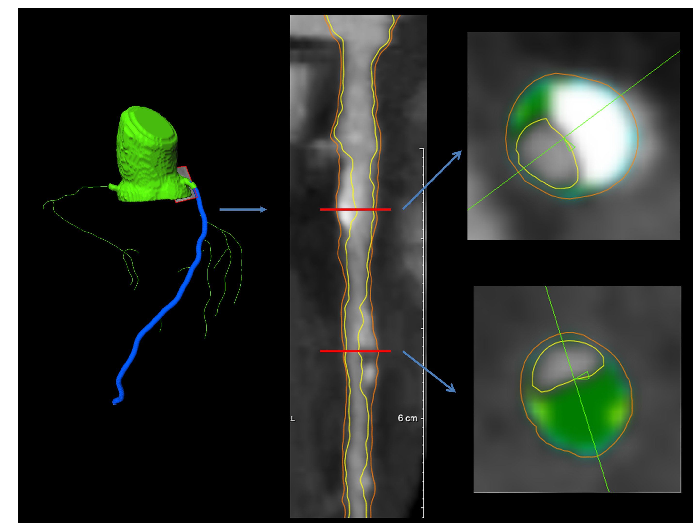 prostatitis cronica tratamiento quirurgico