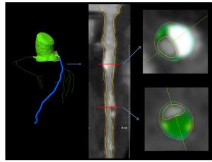 69-Year-Old Man With Castration-Resistant Prostate Cancer Progressing After Docetaxel and Androgen Receptor-Targeting Agent