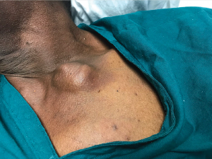 Unusual Initial Presentation of Hepatocellular Carcinoma as a Clavicular Head Mass