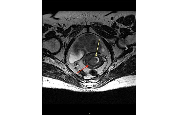 Endometrial cancer | mitochondrial supercomplex assembly