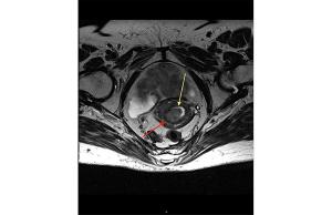 Endometrial cancer | mitochondrial supercomplex assembly