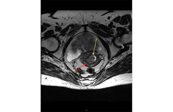 Endometrial cancer | mitochondrial supercomplex assembly