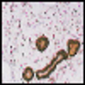 Biphasic Tumors of the Female Genital Tract