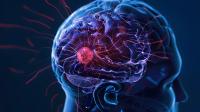 Age Should Not Be Used to Indicate Chemoradiotherapy in Low-Grade Glioma: © 波 刘 - stock.adobe.com