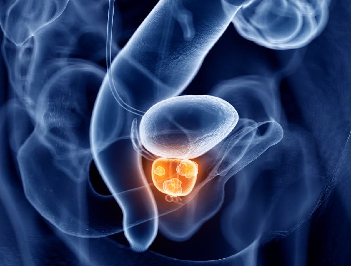 De Novo mCSPC Responds to Additional Abiraterone, Prednisone Along With SOC