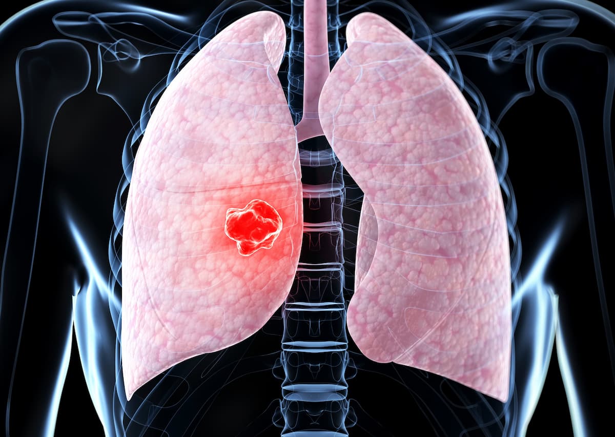 PFS Improves With Dato-DXd Vs Docetaxel In Advanced NSCLC Subgroups