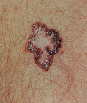 ONS 2014: Updates in Melanoma