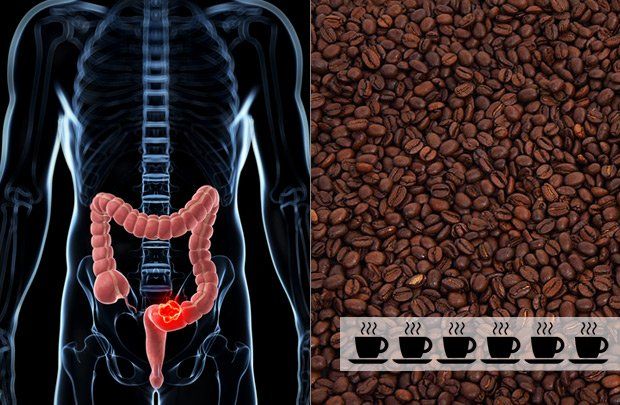 Coffee and colon cancer risk