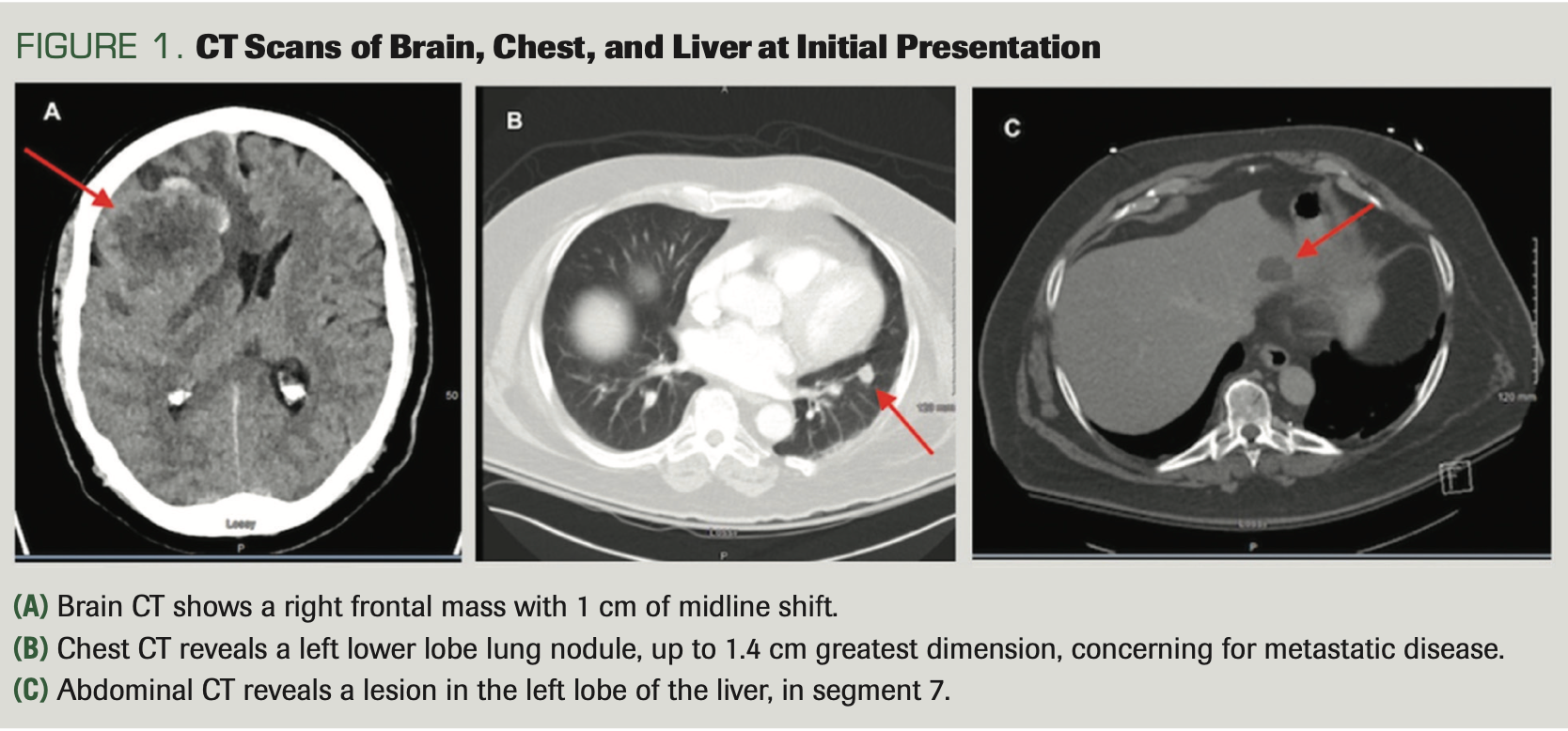 FIGURE 1. CT Scans of Brain, Chest, and Liver at Initial Presentation