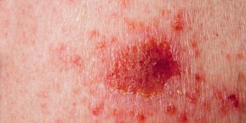 New guidelines for both cancer types provide detailed and distinct criteria for diagnoses, staging, use of IGRST, and follow up, among other areas.