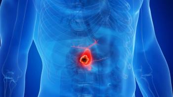 Chemoradiotherapy resulted in lower incidence of local progression, prompting an evaluation of resectability in patients with advanced gallbladder cancers.