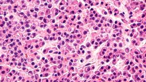 multiple myeloma