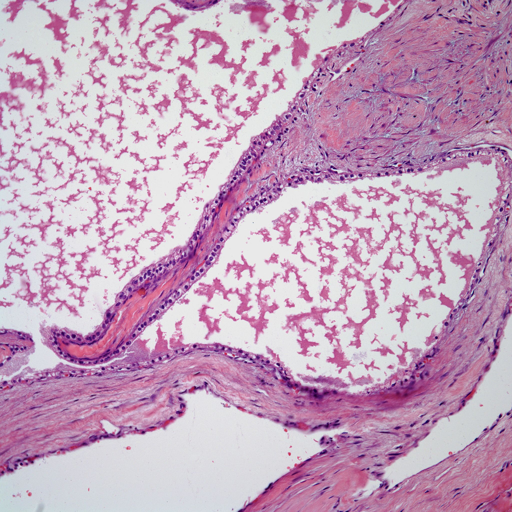 What Caused Abdominal Pain in This 68-Year-Old Woman?