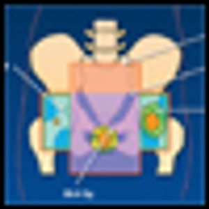 Intensity-Modulated Radiation Therapy for Anal Cancer