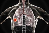 Patients with squamous NSCLC who received ivonescimab plus chemotherapy as first-line treatment had delayed deterioration in global health status.