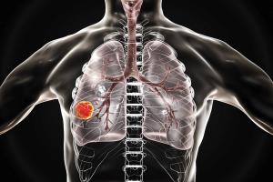 Evaluating the Top EGFR+ NSCLC Treatment Combinations