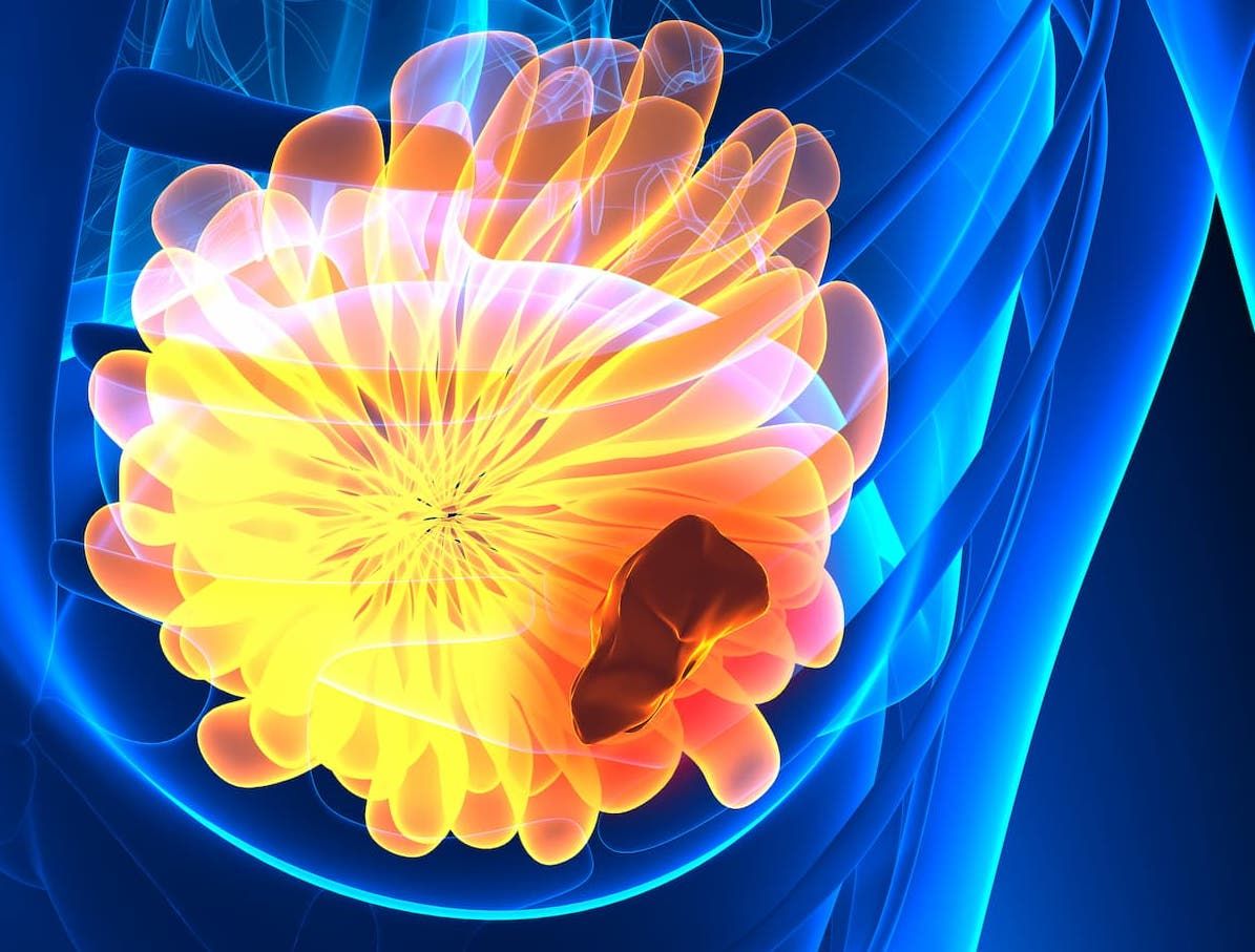 Sacituzumab Govitecan Bests Chemotherapy in HR+/HER2– Metastatic Breast Cancer With ET Resistance