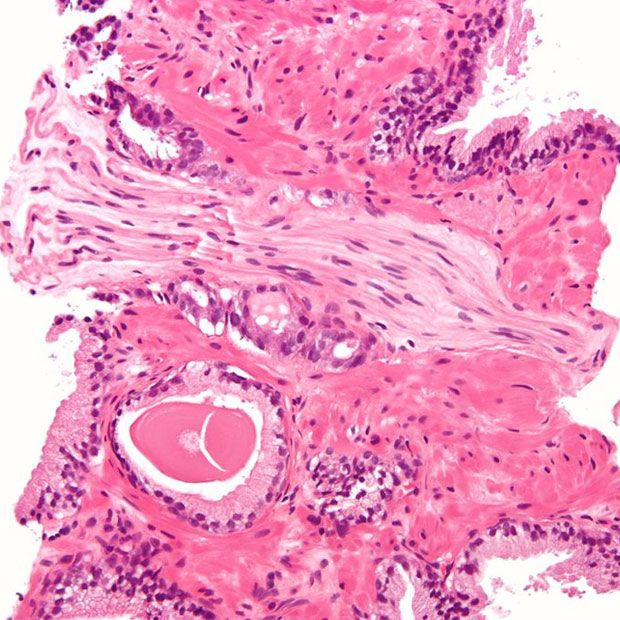 Micrograph of prostate adenocarcinoma 