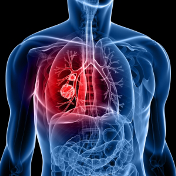 Sunil Singhal, MD, discussed how fluorescence imaging via abenacianine helps surgeons visualize tumors missed during lung cancer surgery.